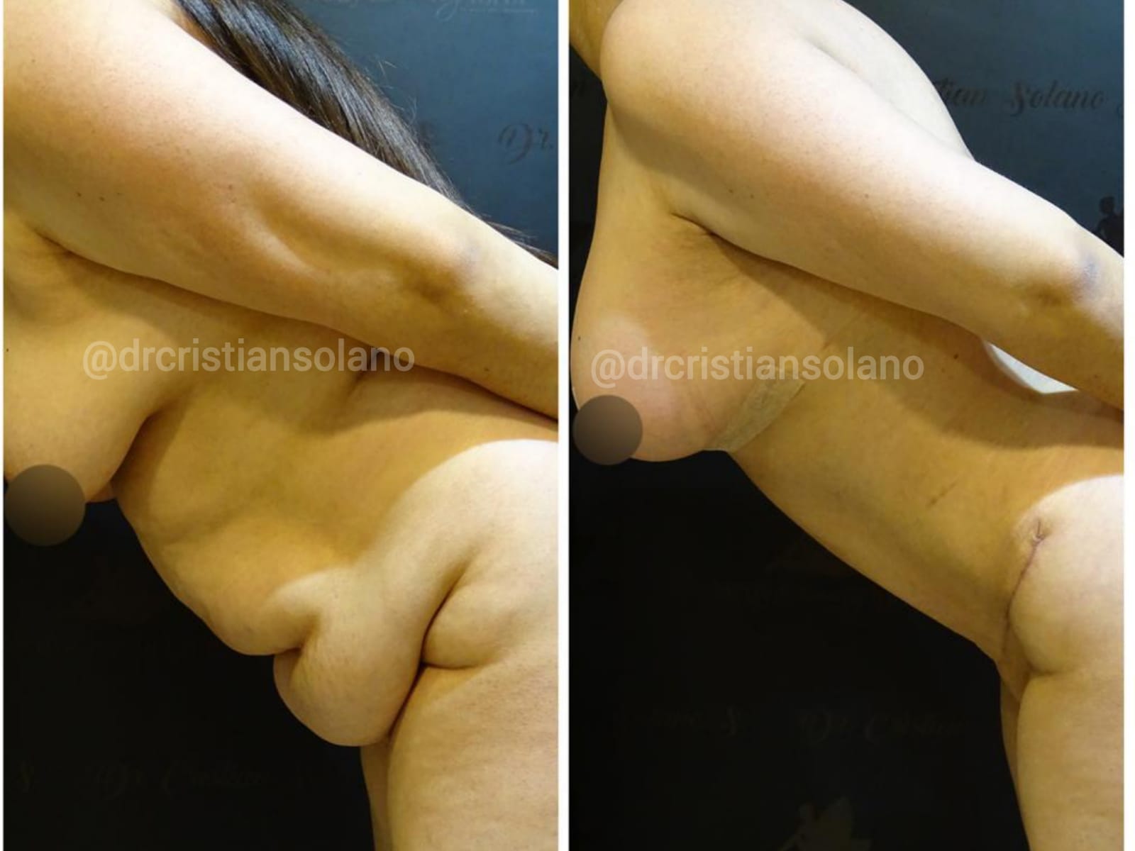abdominoplastia-ecuador