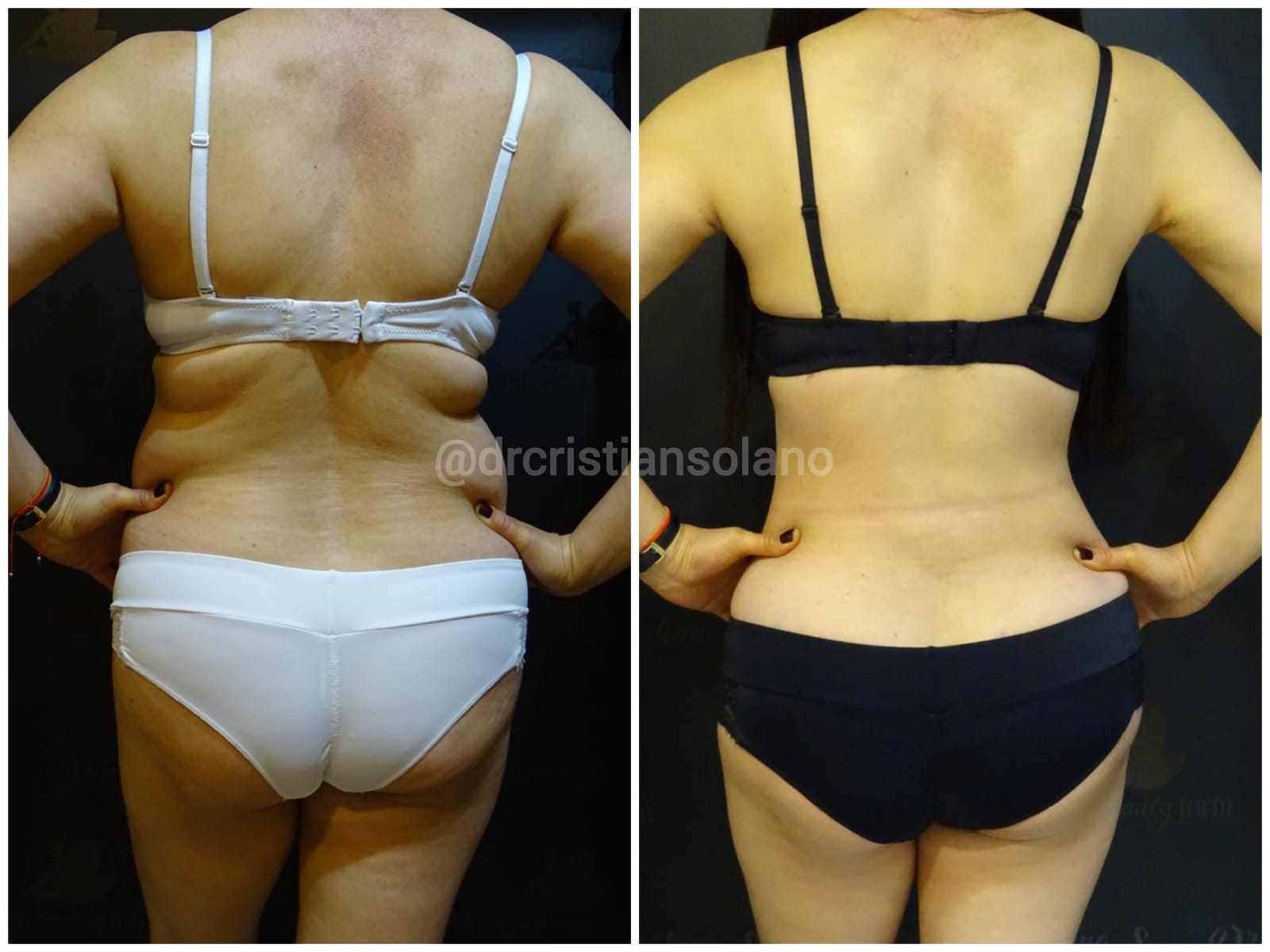 ecuador-abdominoplastia