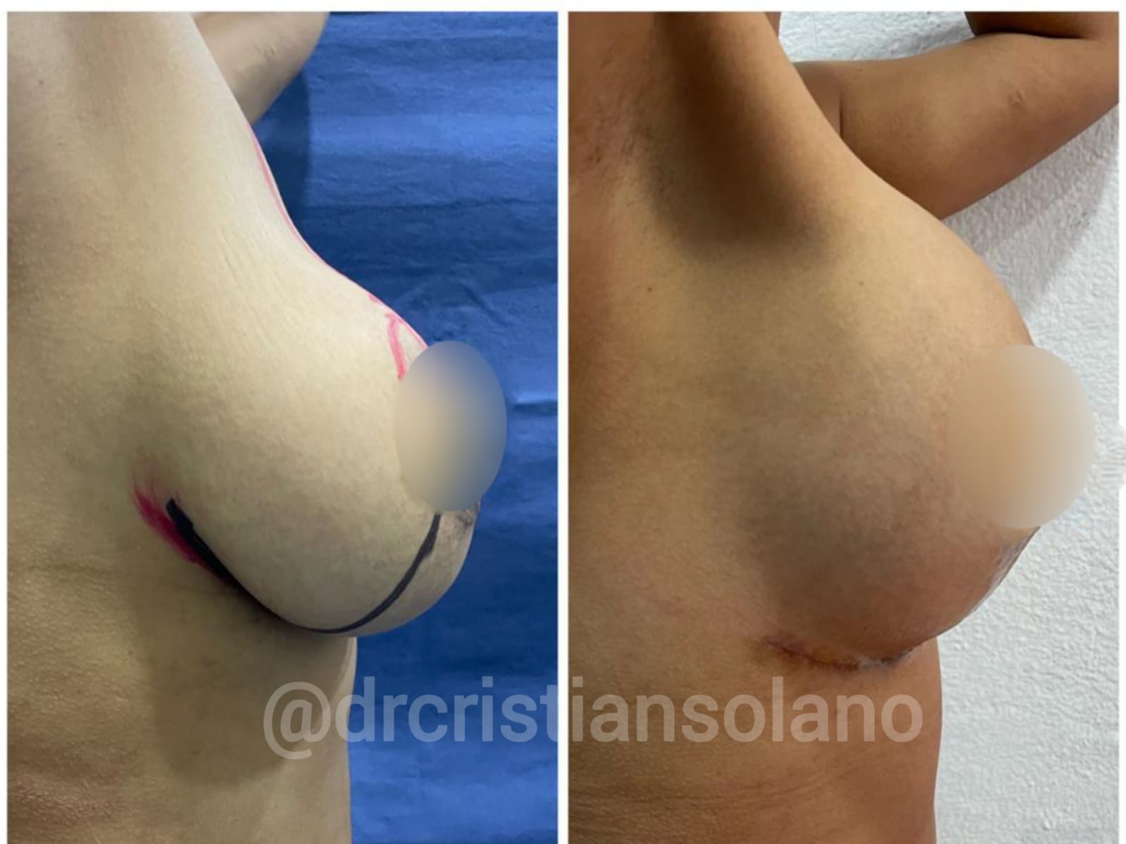 ecuador-mamoplastia-aumento
