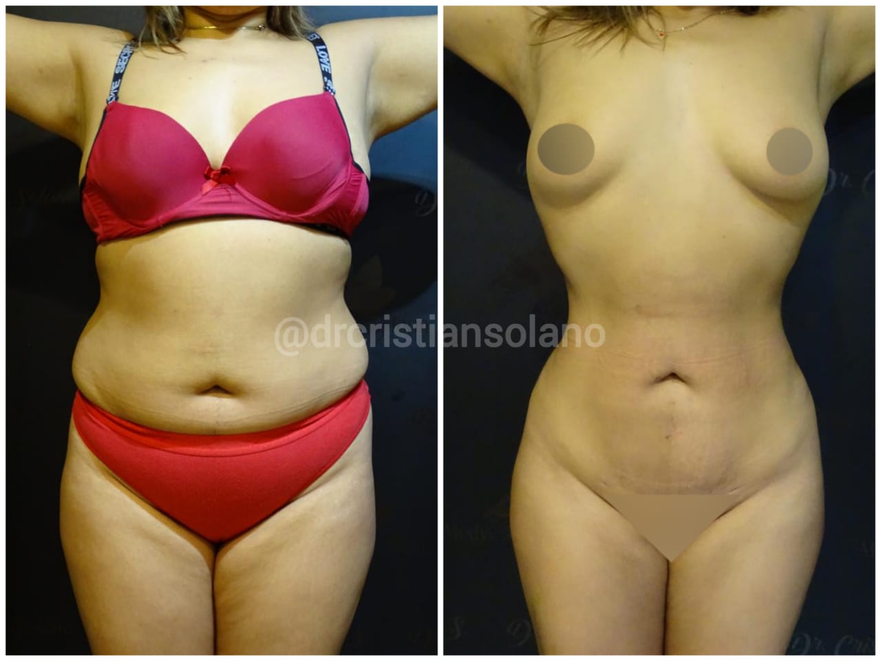 lipoescultura-en-Ecuador