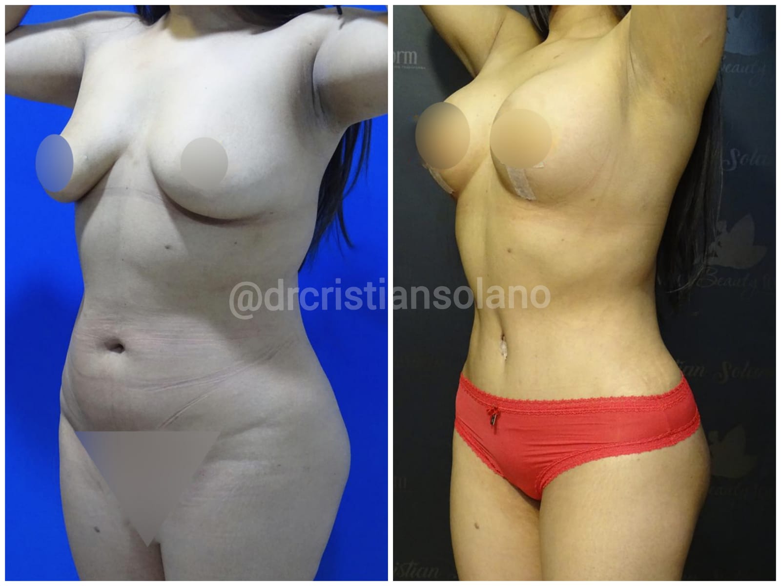 mamoplastia-aumento-cuenca-ecuador