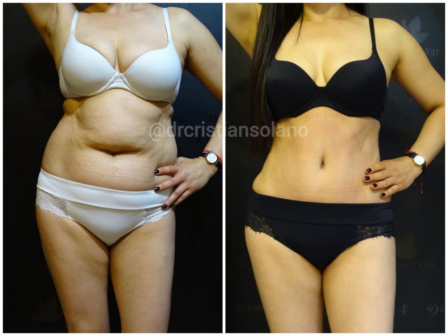mejor-abdominoplastia-1536x1152