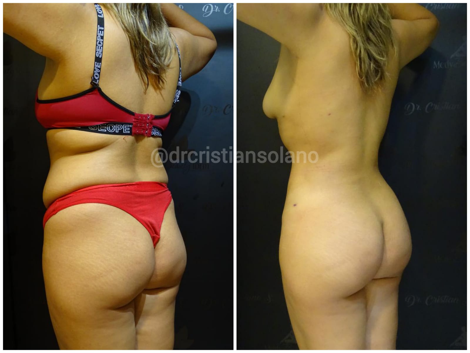 mejor-lipoescultura-en-Ecuador