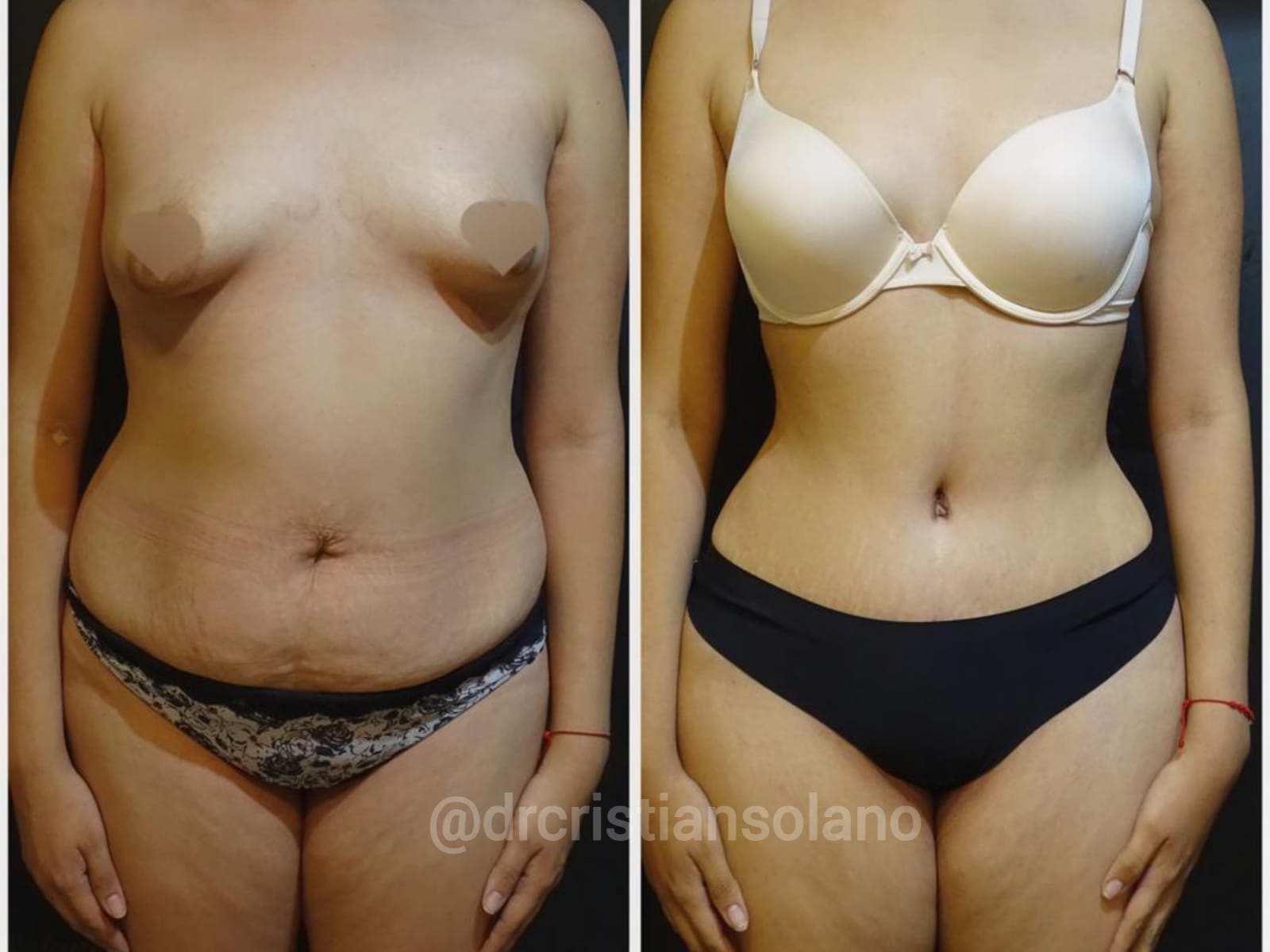 resultados-abdomnoplastia