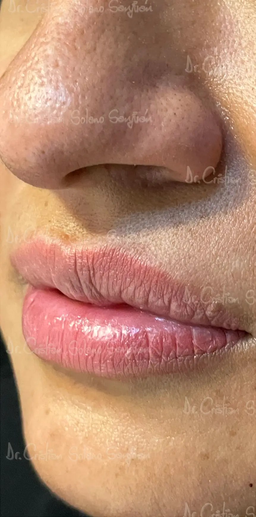 dr-cristian-solano-estetico-relleno-labial
