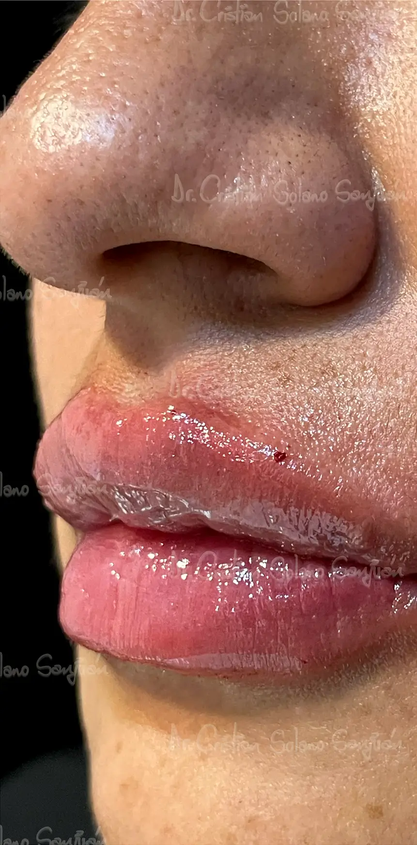 dr-cristian-solano-esteticos-rellenos-de-labio-1