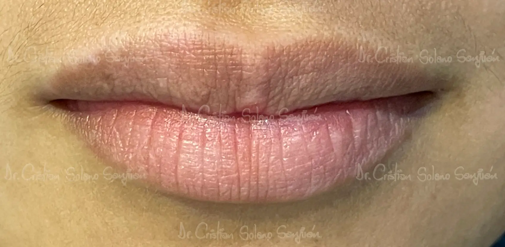 dr-cristian-solano-esteticos-rellenos-de-labio-2