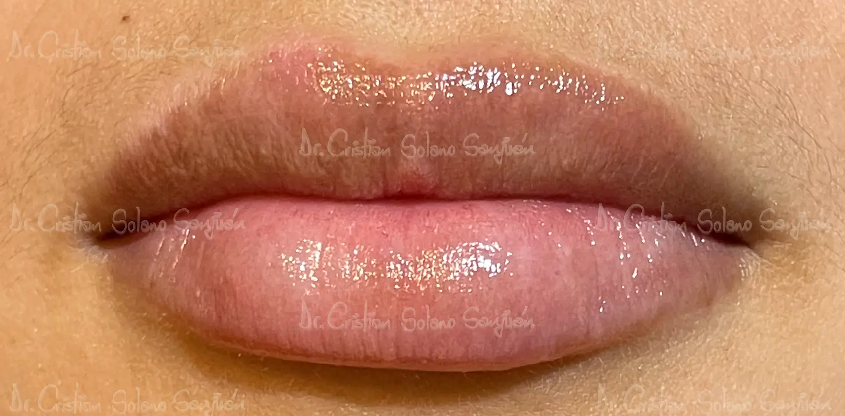 dr-cristian-solano-esteticos-rellenos-de-labio-3