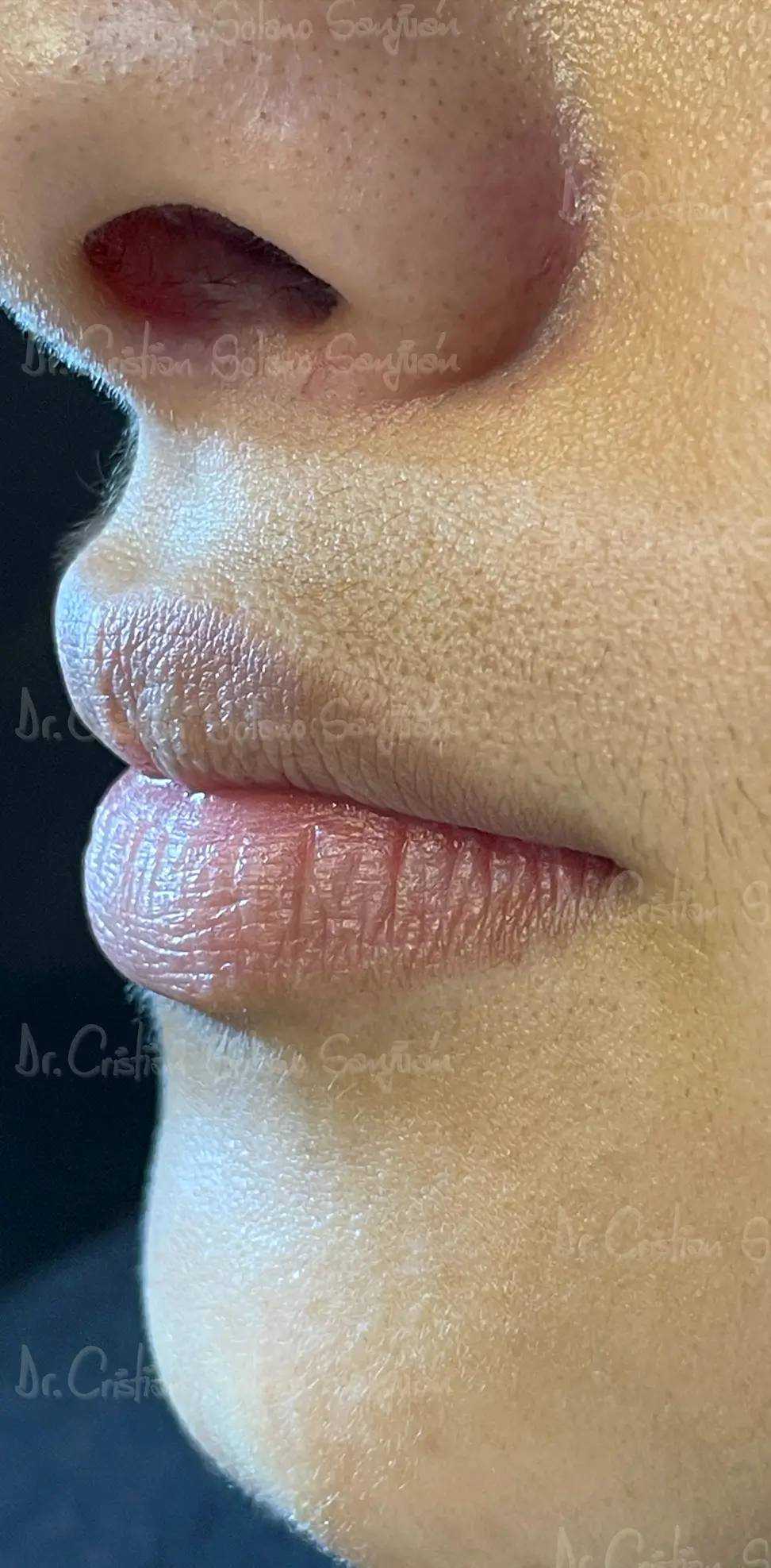 dr-cristian-solano-esteticos-rellenos-de-labio-4