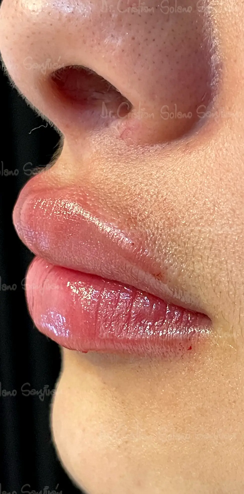 dr-cristian-solano-esteticos-rellenos-de-labio-5