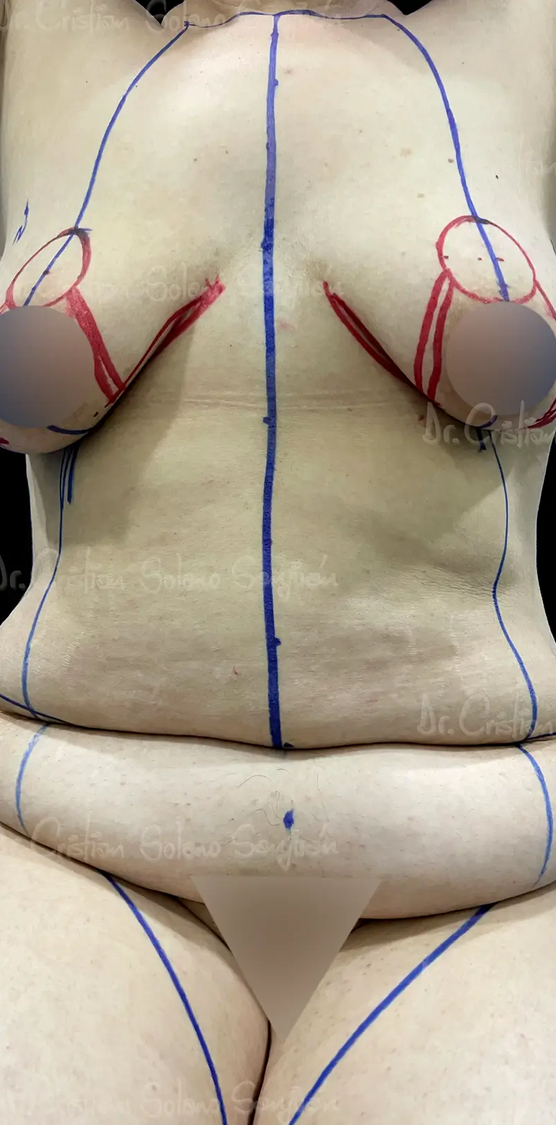 dr-cristian-solano-servicio-abdominoplastia-11
