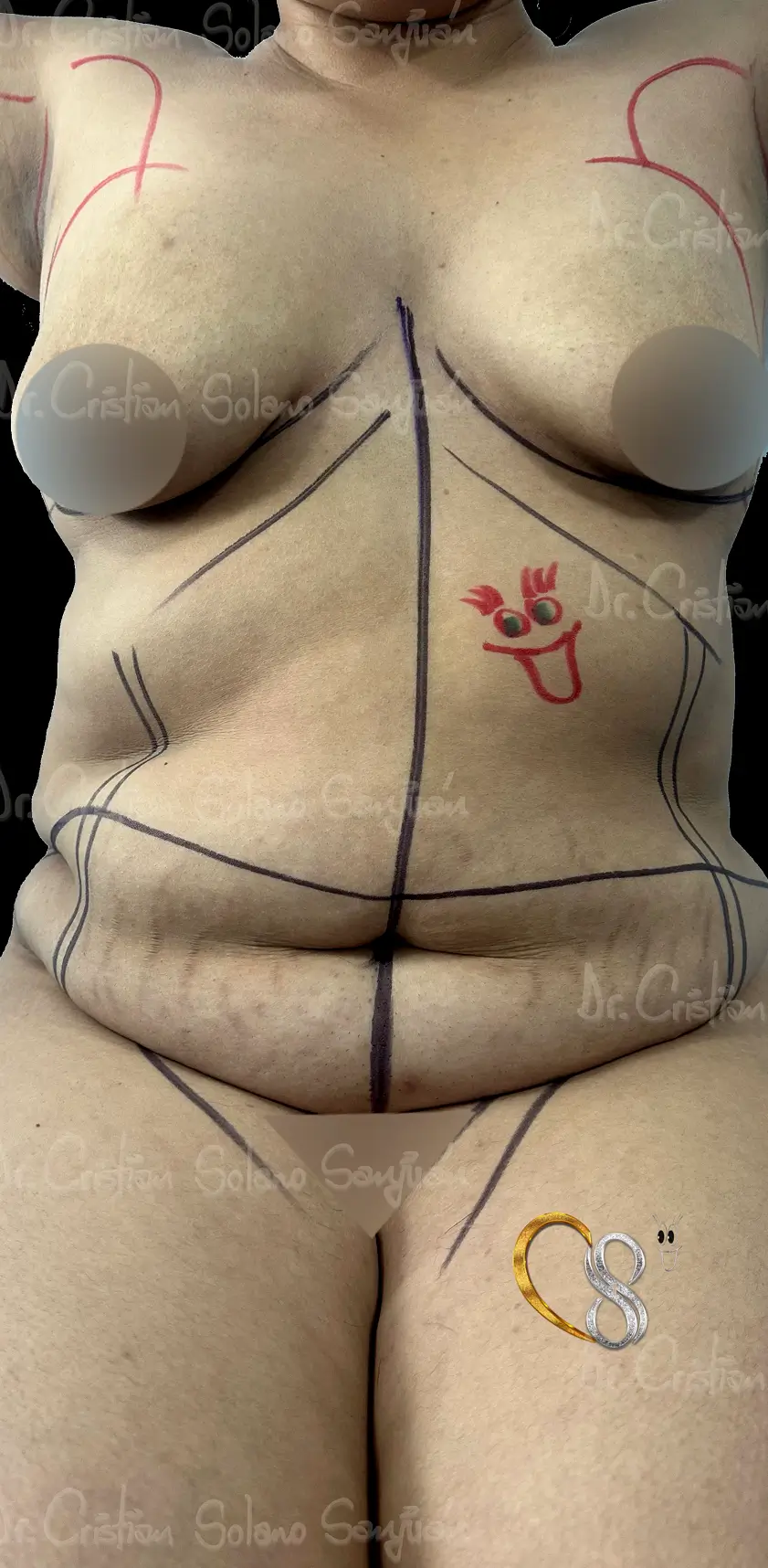 dr-cristian-solano-servicio-abdominoplastia-12