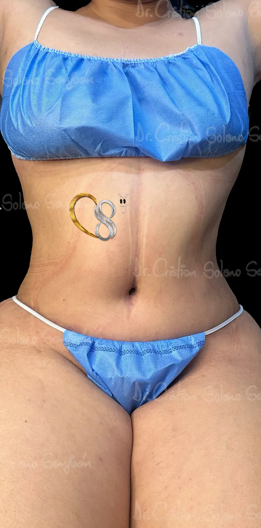dr-cristian-solano-servicio-abdominoplastia-14