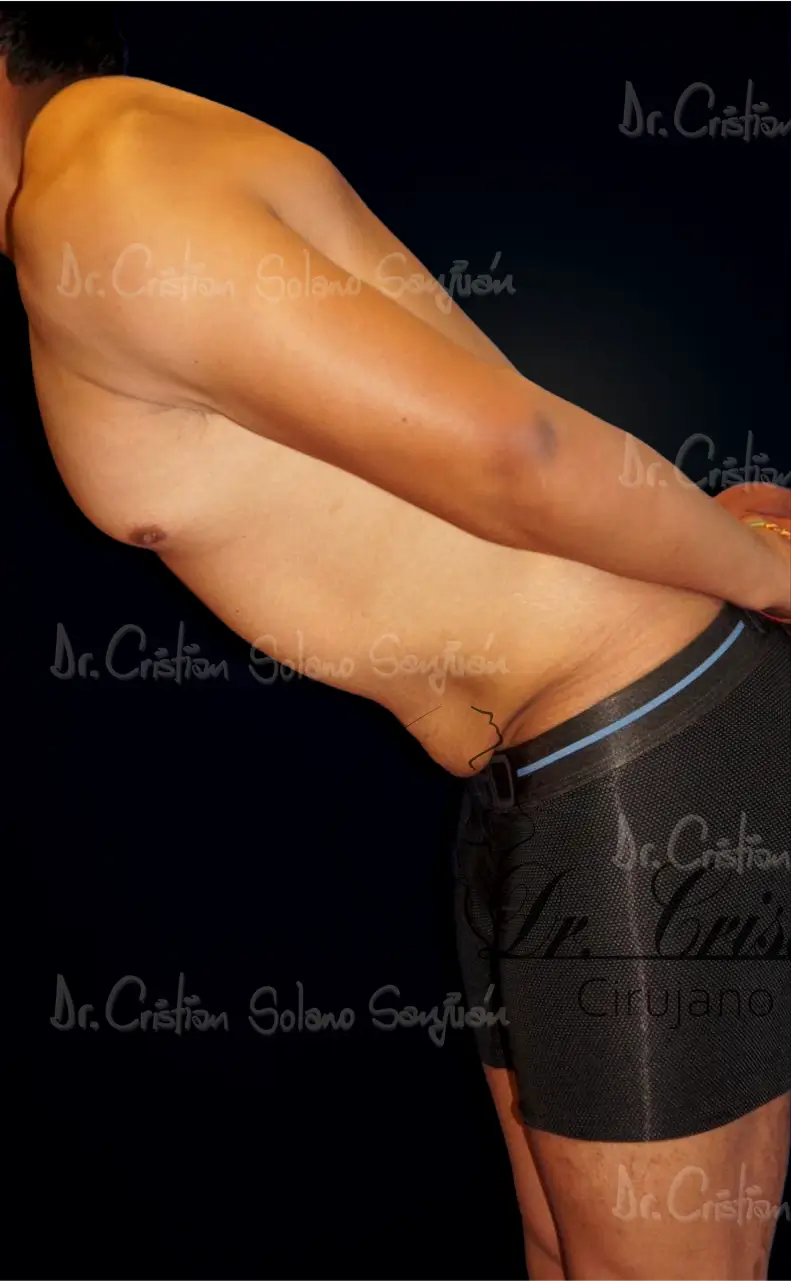 dr-cristian-solano-servicio-abdominoplastia-15