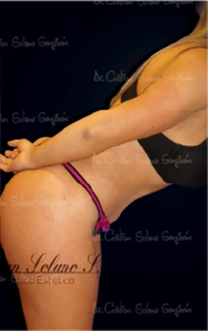 dr-cristian-solano-servicio-abdominoplastia-18