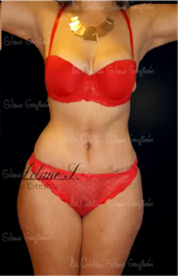 dr-cristian-solano-servicio-abdominoplastia-20