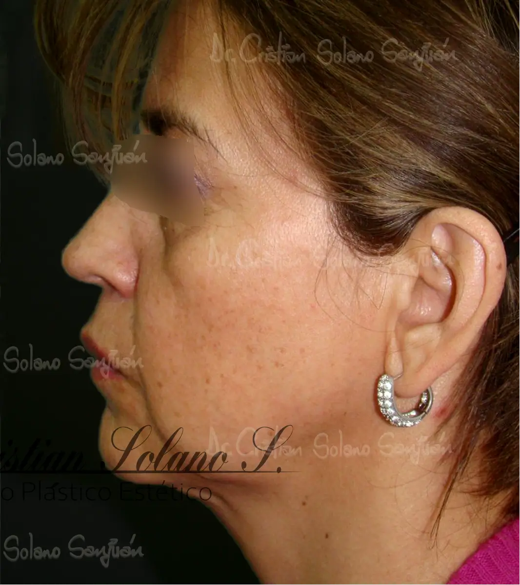 dr-cristian-solano-servicio-cirugia-de-cuello-1