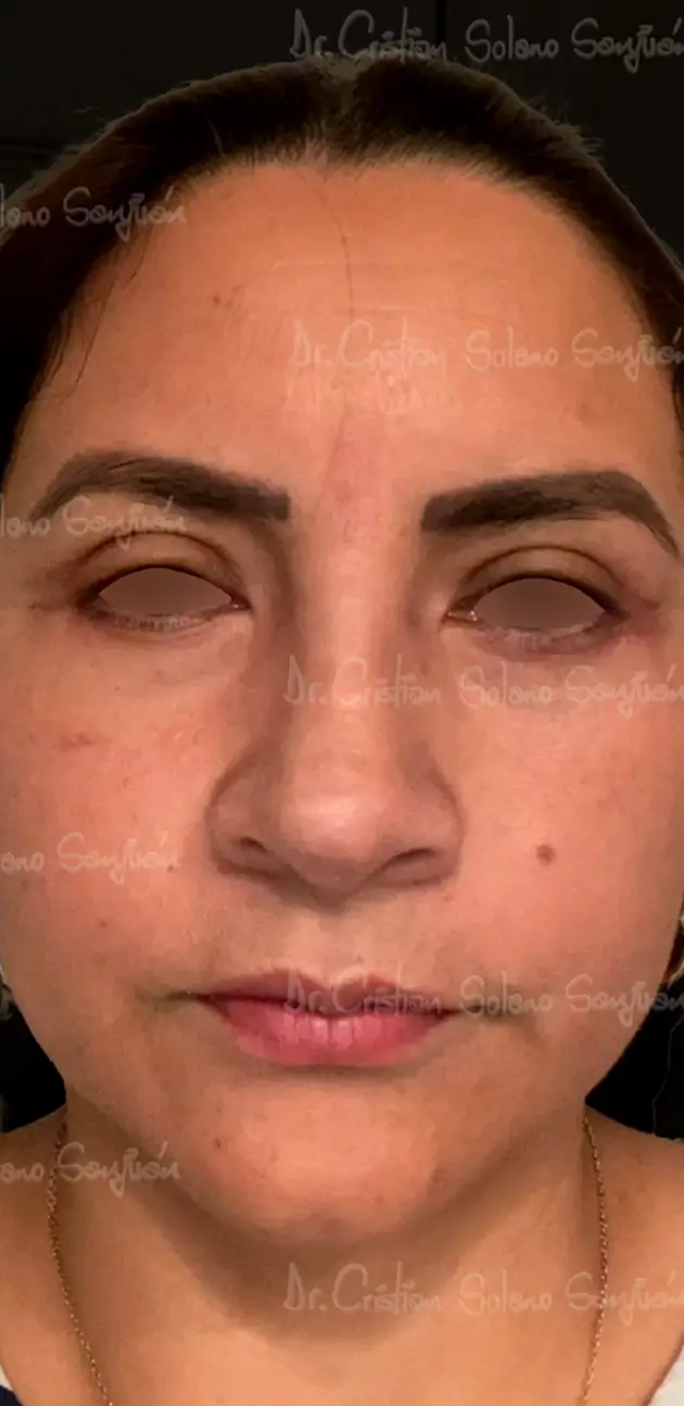 dr-cristian-solano-servicio-cirugia-de-parpados6