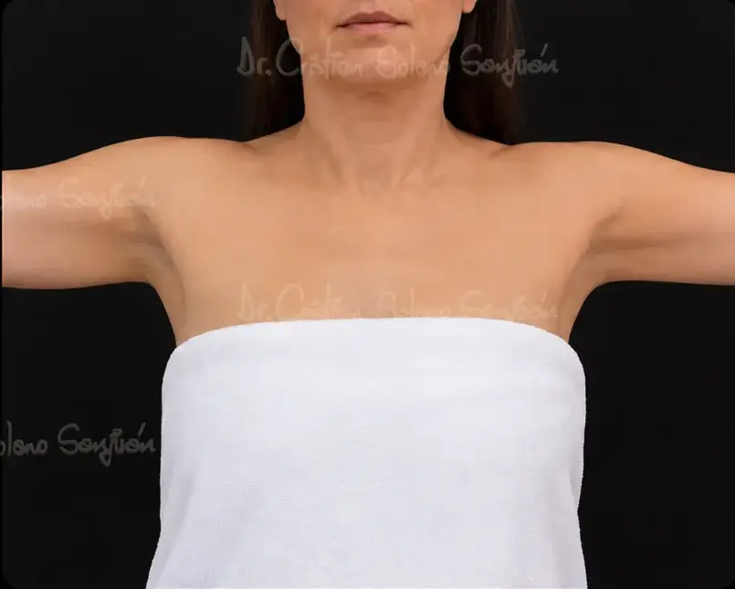 dr-cristian-solano-servicio-cirugia-debrazos-despues