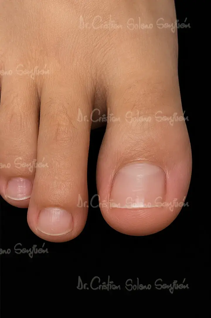 dr-cristian-solano-servicio-eliminacion-de-onicomicosis-1