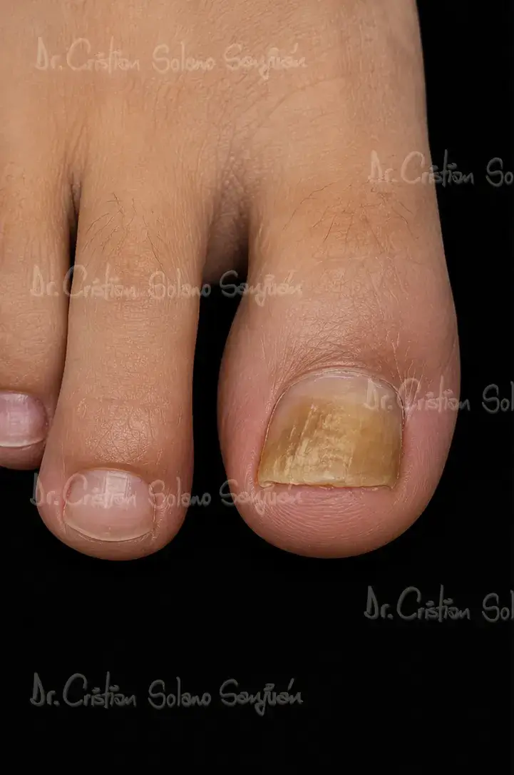 dr-cristian-solano-servicio-eliminacion-de-onicomicosis