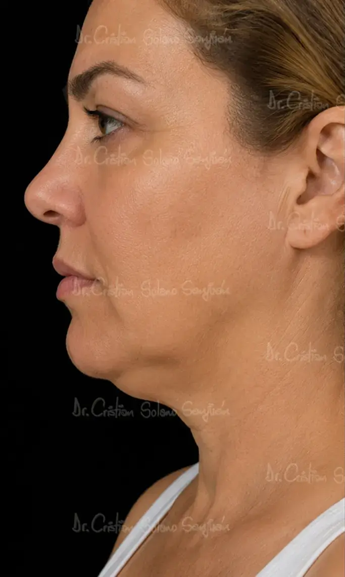 dr-cristian-solano-servicio-endolift-antes
