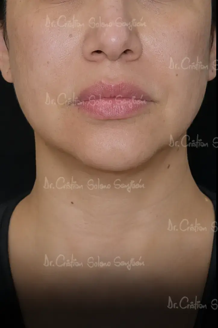 dr-cristian-solano-servicio-extraccion-de-biopolimeros-antes