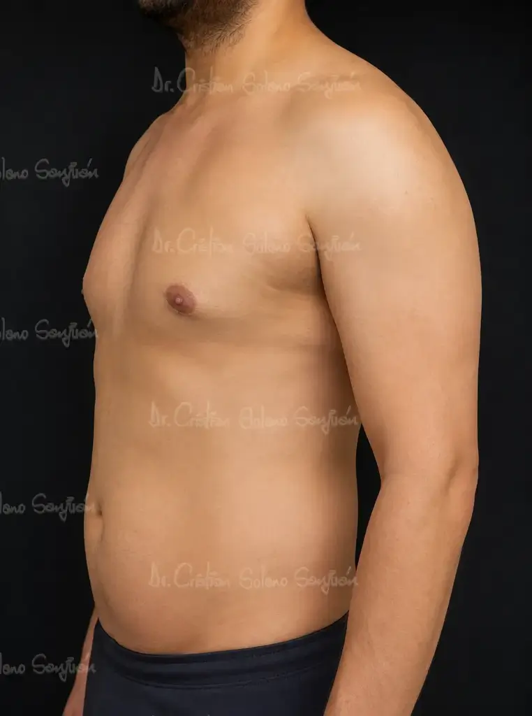 dr-cristian-solano-servicio-ginecomastia-despues