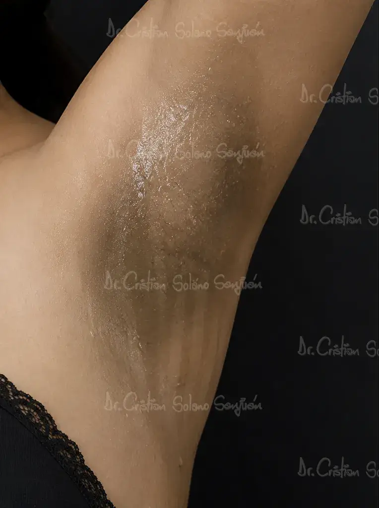 dr-cristian-solano-servicio-hiperhidrosis-antes