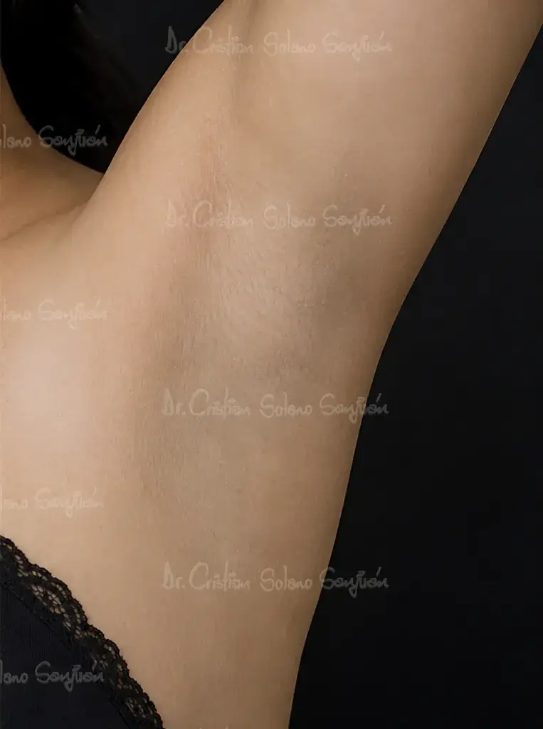 dr-cristian-solano-servicio-hiperhidrosis-despues