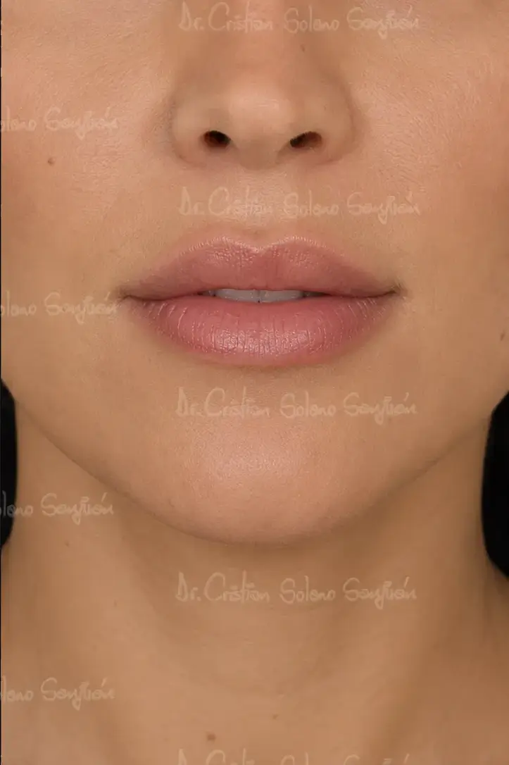dr-cristian-solano-servicio-lifting-de-labios-1