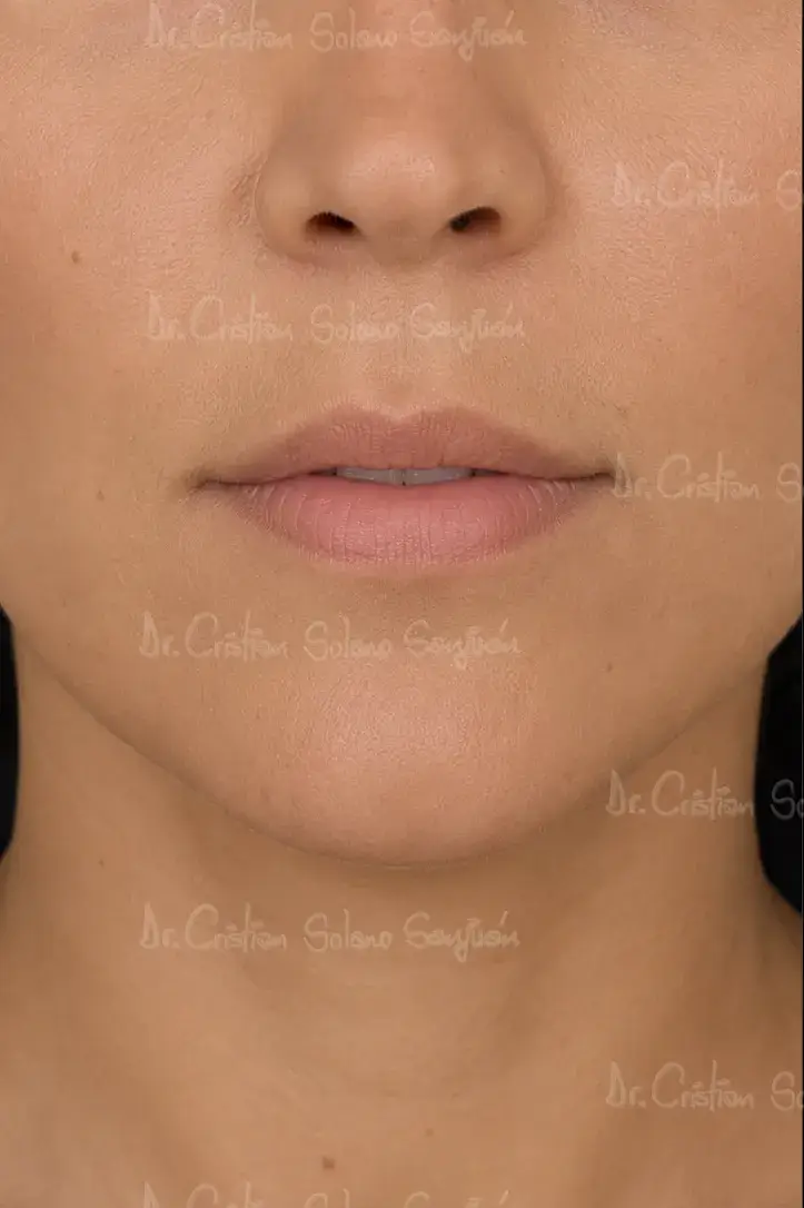 dr-cristian-solano-servicio-lifting-de-labios