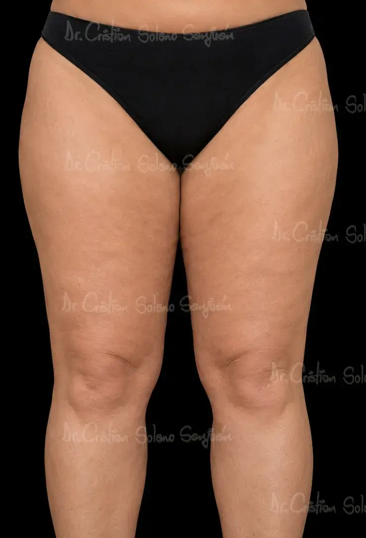 dr-cristian-solano-servicio-lifting-de-piernas-antes