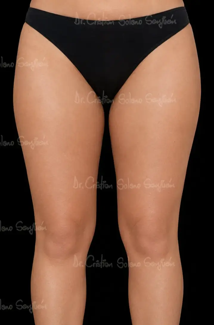 dr-cristian-solano-servicio-lifting-de-piernas-despues