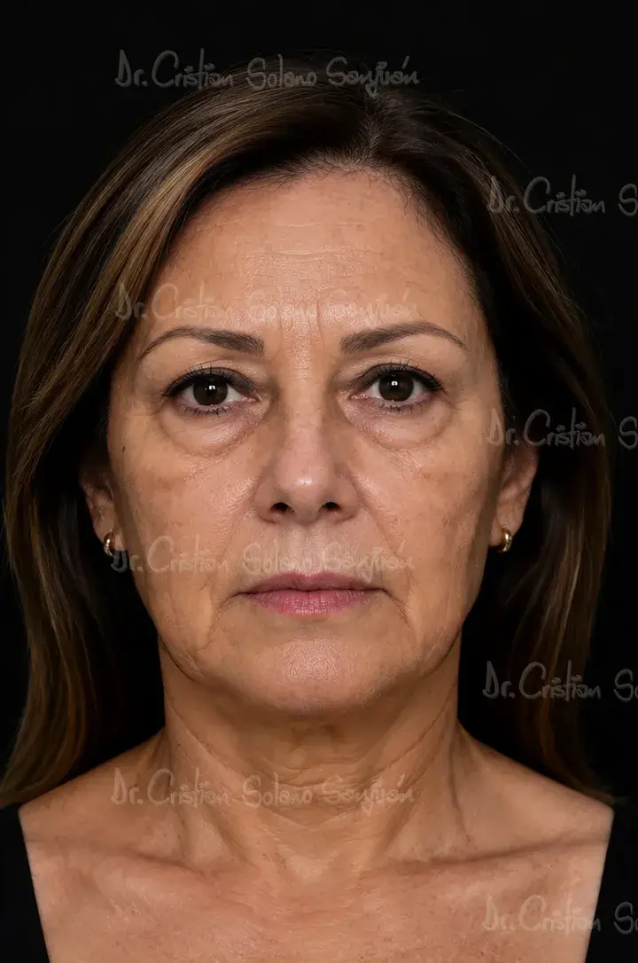 dr-cristian-solano-servicio-lifting-facial-antes