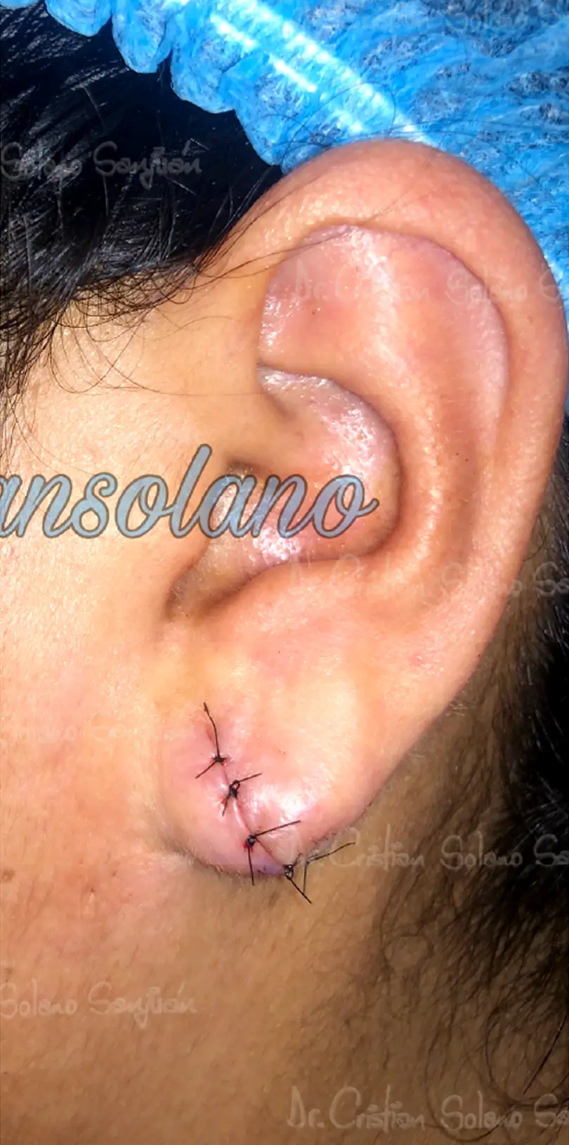 dr-cristian-solano-servicio-lobulo-de-la-oreja-1