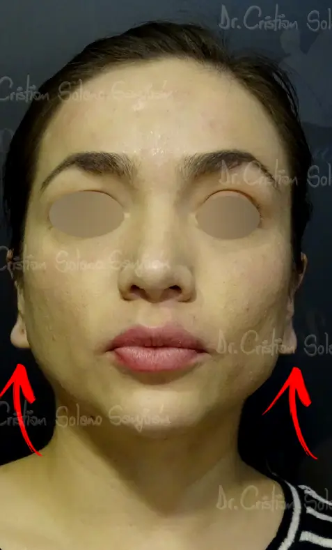 dr-cristian-solano-servicio-lobulo-de-la-oreja-2png