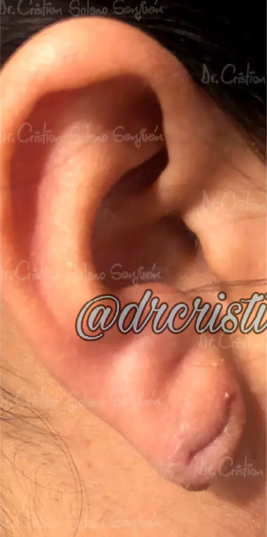 dr-cristian-solano-servicio-lobulo-de-la-oreja-4