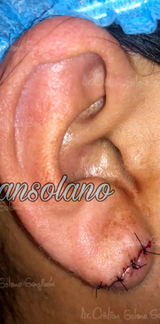 dr-cristian-solano-servicio-lobulo-de-la-oreja-5