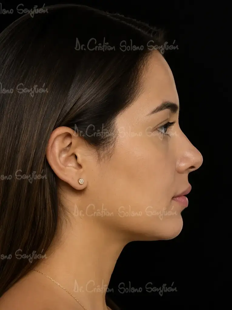 dr-cristian-solano-servicio-mentoplastia-despues