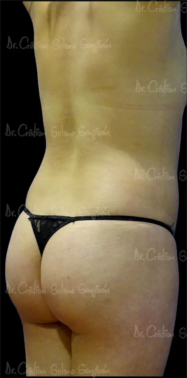 dr-cristian-solano-servicio-modelamiento-de-gluteo