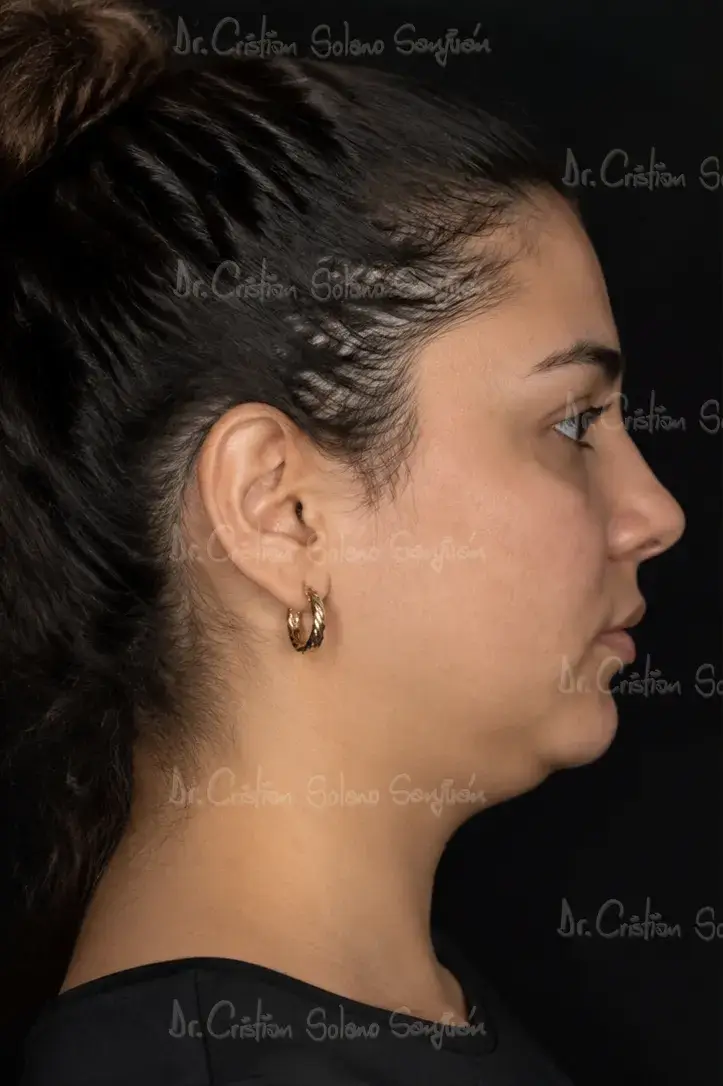 dr-cristian-solano-servicio-perfilamiento-facial-antes