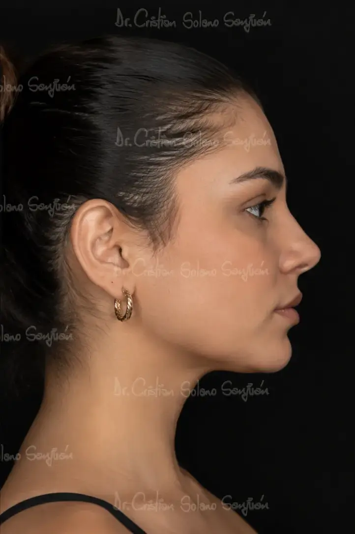 dr-cristian-solano-servicio-perfilamiento-facial-despues