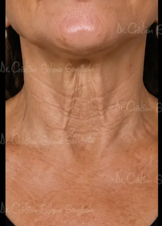 dr-cristian-solano-servicio-rejuvenecimiento-facial-antes