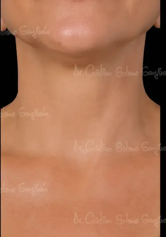 dr-cristian-solano-servicio-rejuvenecimiento-facial-despues