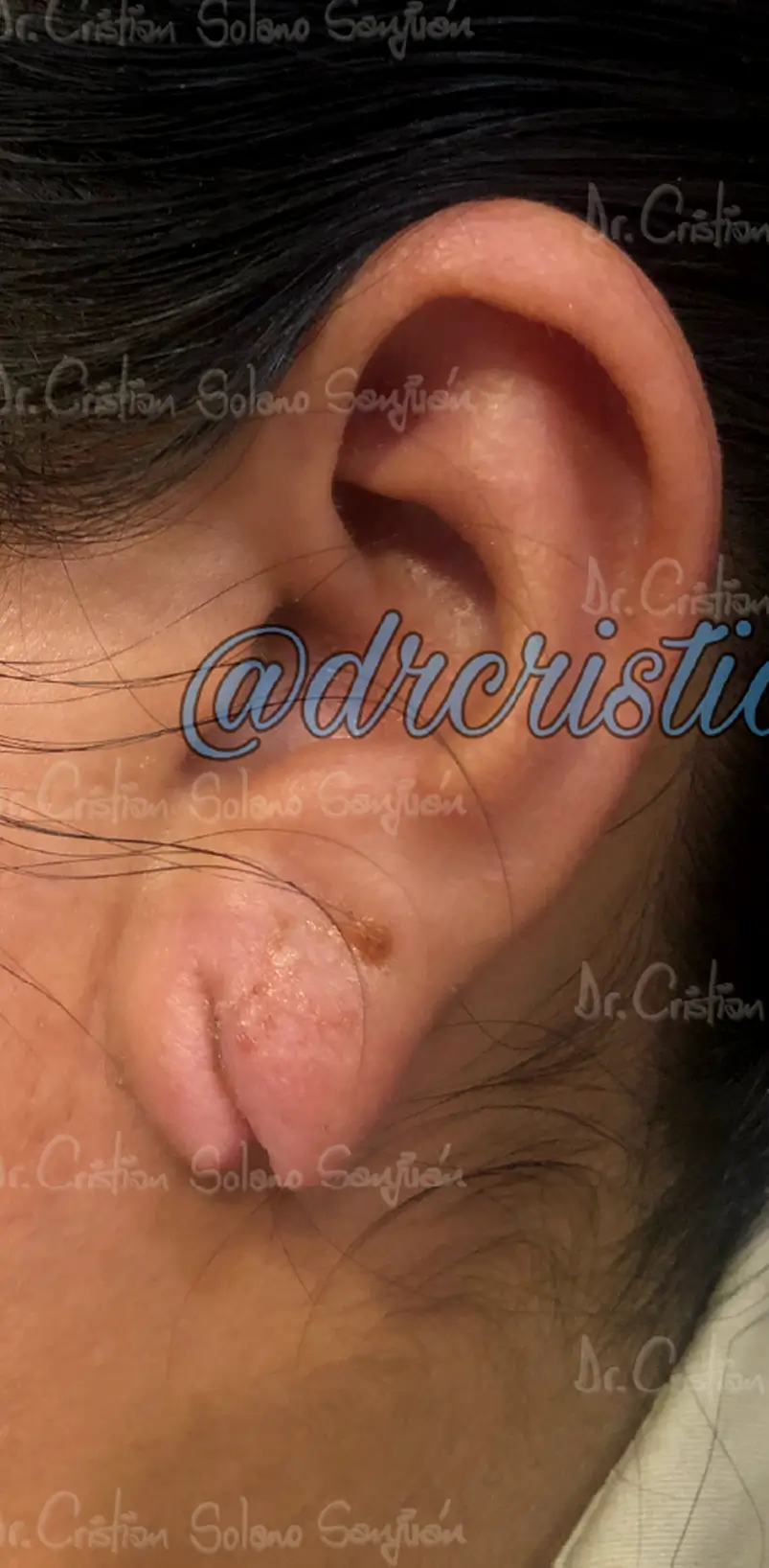 dr-cristians-solano-servicio-lobulo-de-la-oreja
